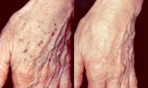 Voor en na behandeling van de handen met Radiesse en tretinoïnecrème