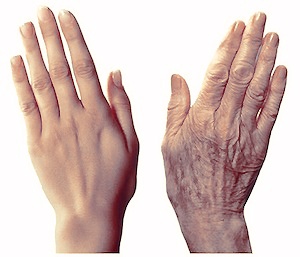 Door afname van het onderhuidse vetweefsel, rimpels pigmentvlekken kunnen handen er verouderd uitzien