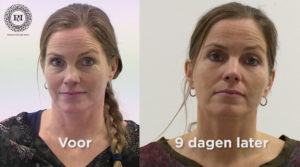Voor en na foto van een vrouw die behandeling heeft ondergaan met plexr plasmabehandeling onder de ogen