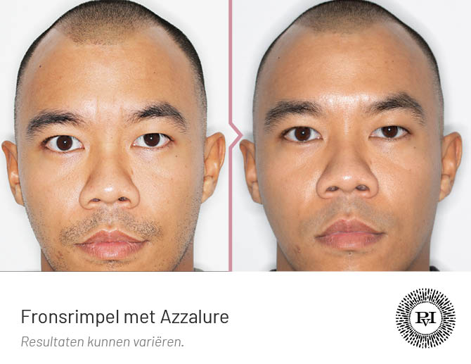 Voor en na foto van de Fronsrimpel behandeling met botox 