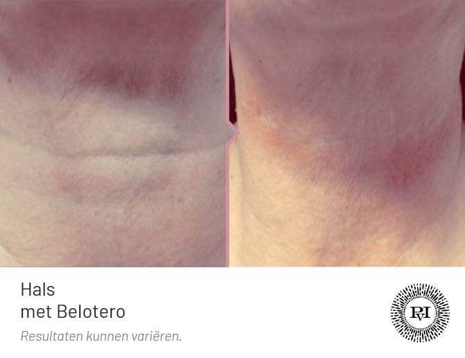 voor en na foto van de hals/nek behandeling met de Belotero filler