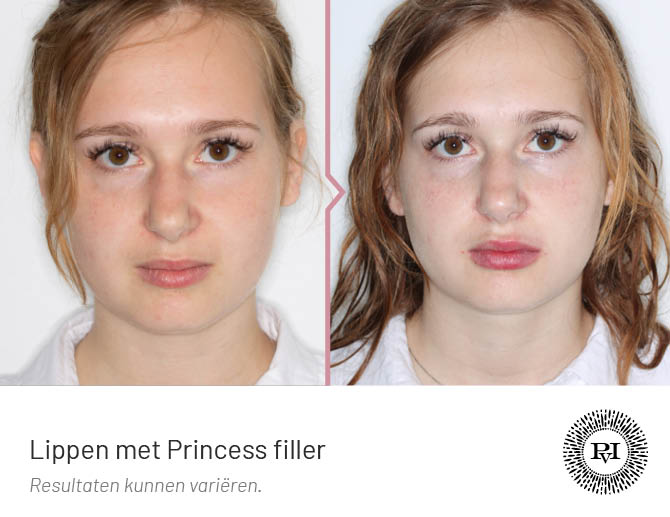 voor en na foto van de lippen behandeling met Princess filler