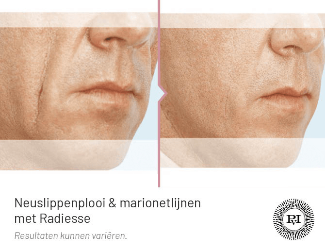 voor en na foto van de neuslippenplooi en marionetlijnen behandeling met Radiesse filler