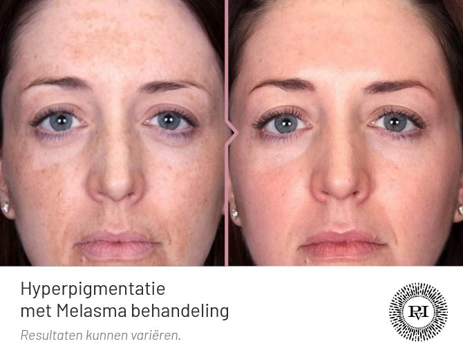 Voor en na hyperpigmentatie Melasma behandeling