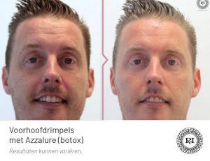 Voor en na foto voorhoofdrimpels behandeling met Azzalure