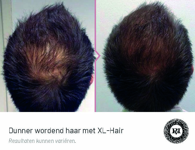 Voor en na kaalheid met XL-Hair
