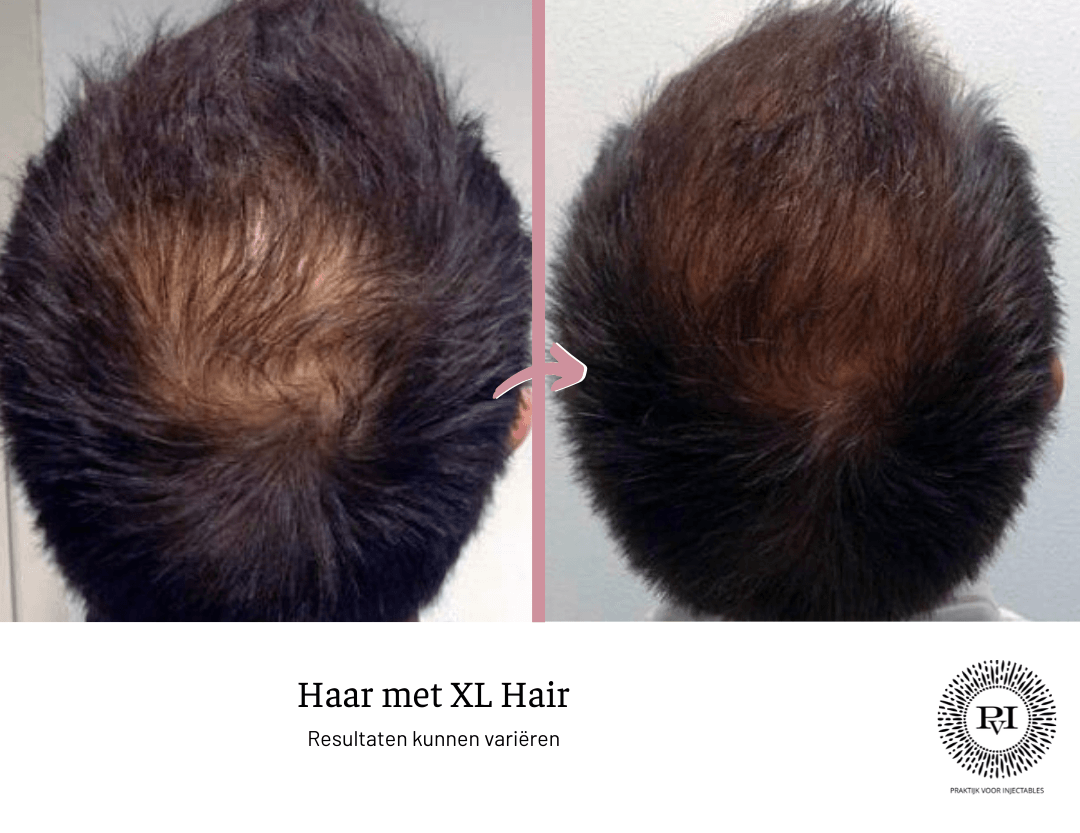 Voor en na foto XL Hair