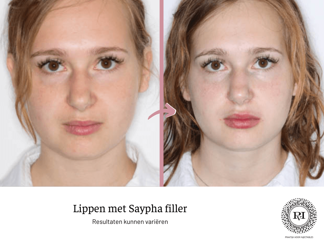Voor en na foto lippen Saypha