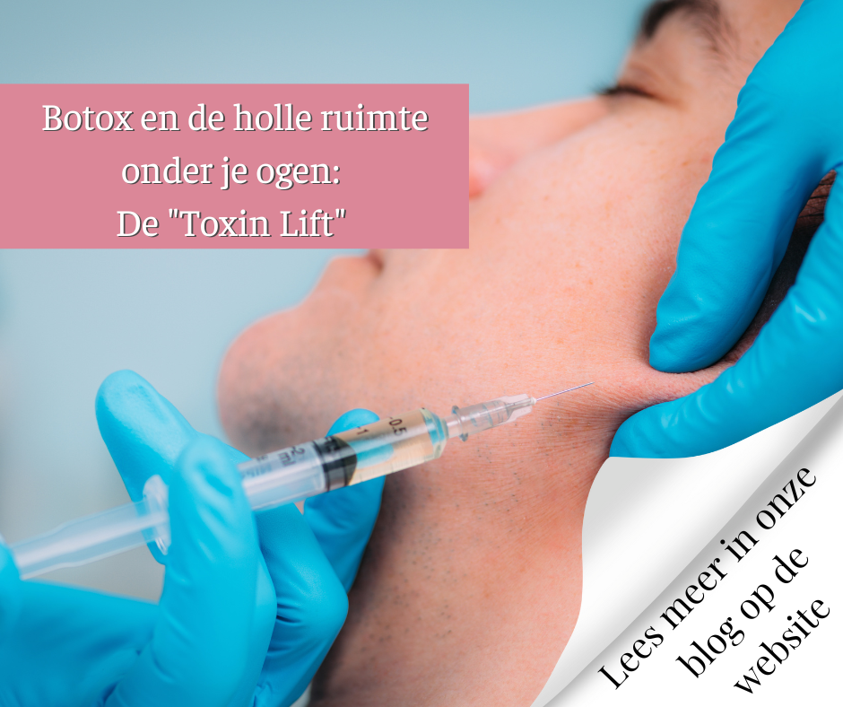Botox en de holle ruimte onder je ogen De Toxin Lift
